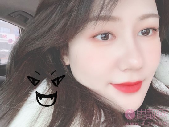 西安第二附属医院美容科陈杰隆鼻怎么样?附价格表及隆鼻效果展示