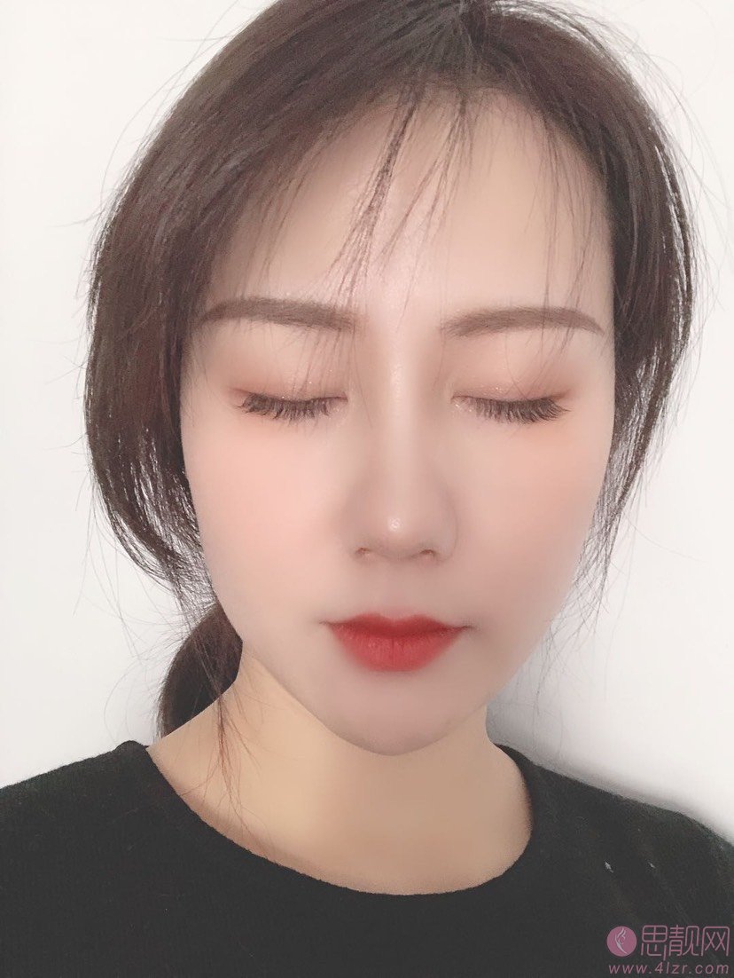 西安第二附属医院美容科陈杰隆鼻怎么样?附价格表及隆鼻效果展示