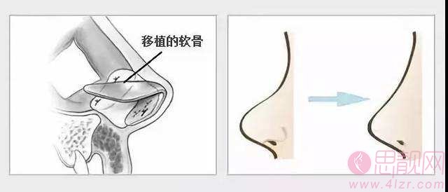 肋软骨隆鼻是永久的吗