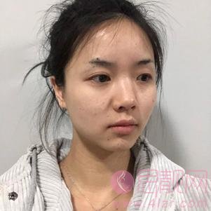 上海韩镜医院任钟赫隆鼻怎么样,2020价格表曝光