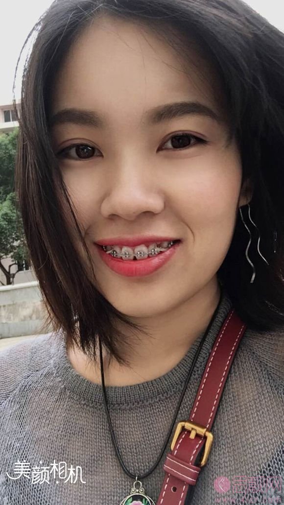深圳成华口腔矫正中心怎么样,2020价格表曝光