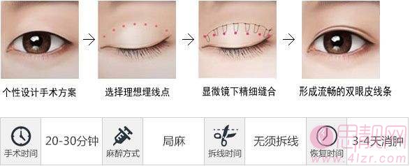 埋线双眼皮恢复多久自然