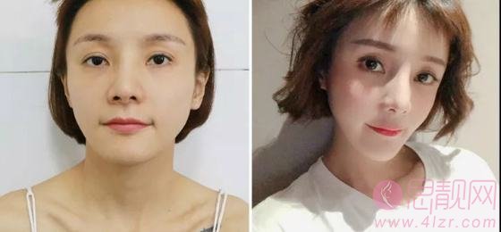 郑州大学第三附属医院整形美容科2020价格表出炉