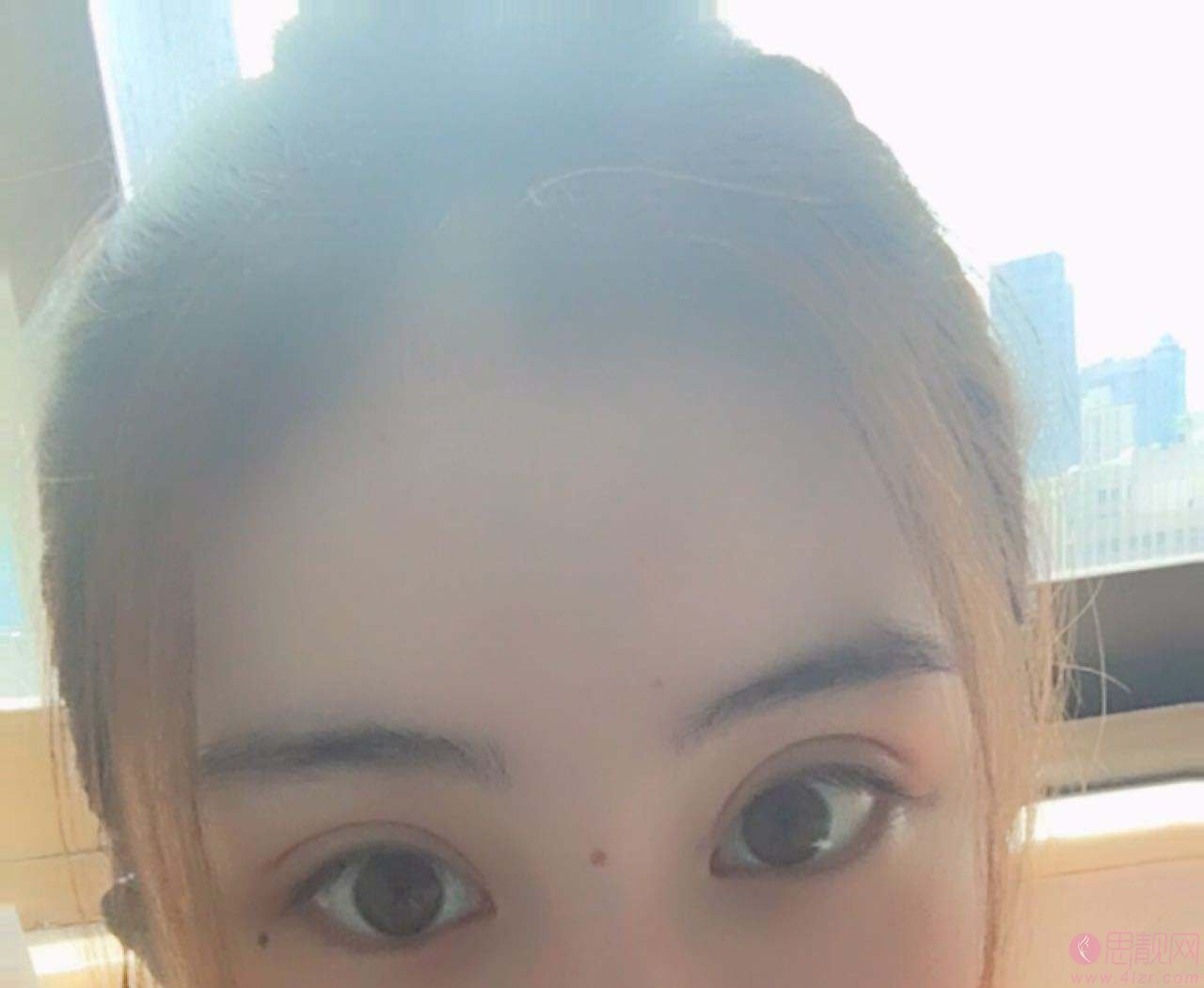 埋线双眼皮能维持几年