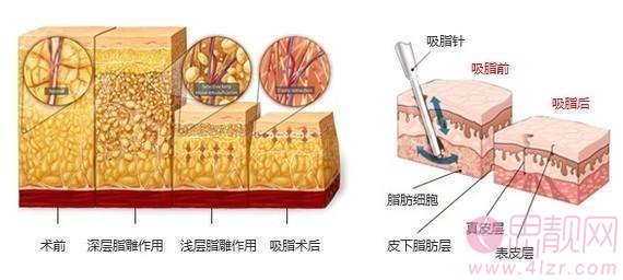 腰腹吸脂后还会反弹吗?