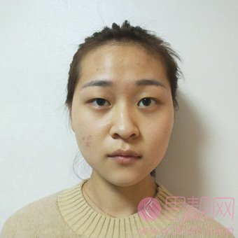 阜阳黛莱美整形李进超做双眼皮怎么样？2020价格表出炉+双眼皮案例一览
