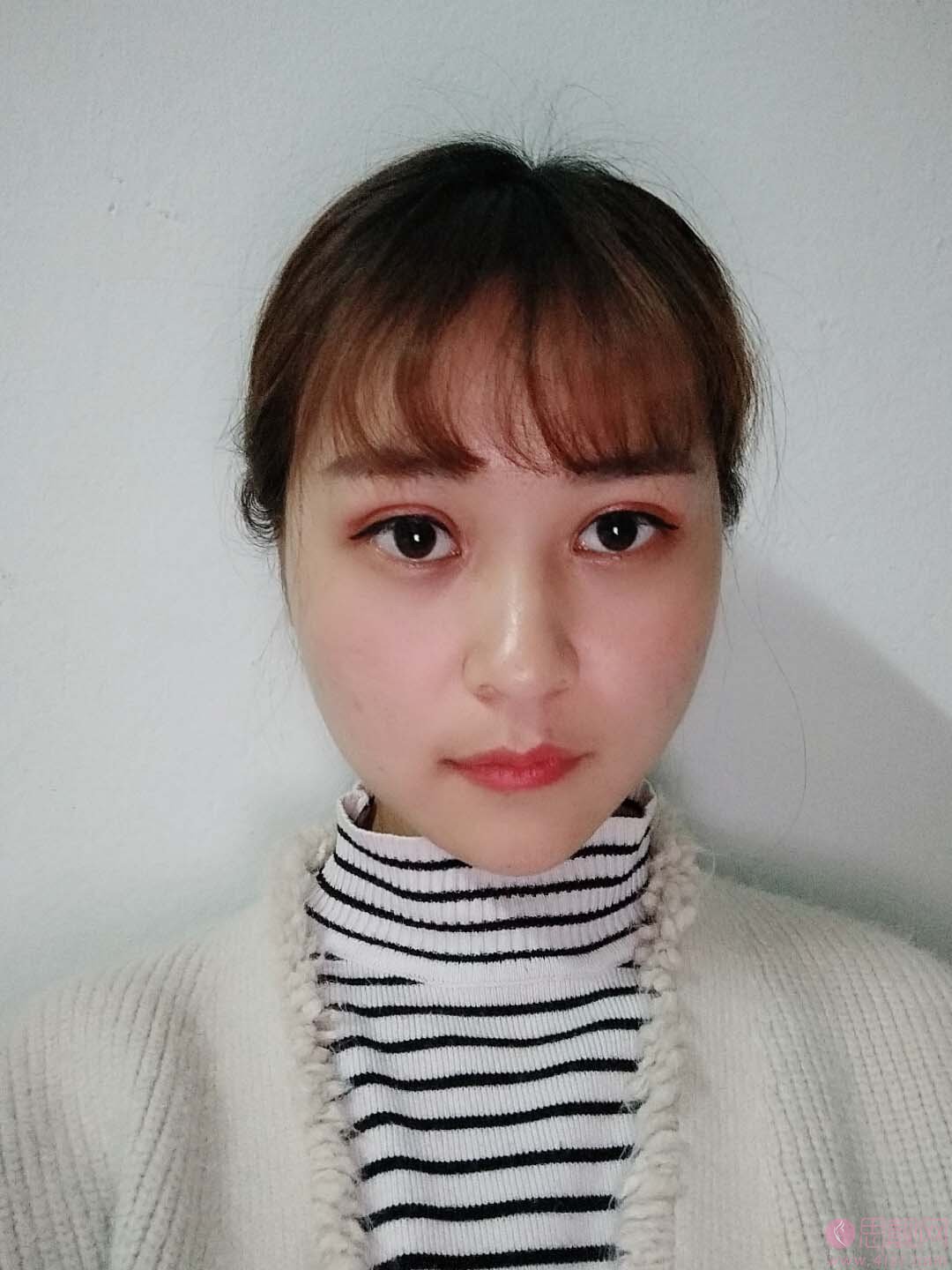 阜阳黛莱美整形李进超做双眼皮怎么样？2020价格表出炉+双眼皮案例一览