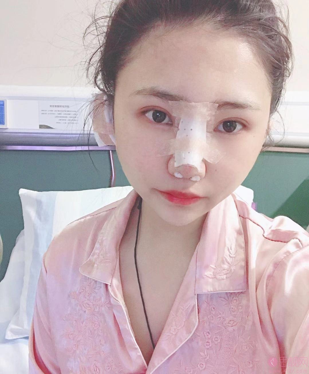 丽水华美整形医院2020价格表？附隆鼻真人案例分享