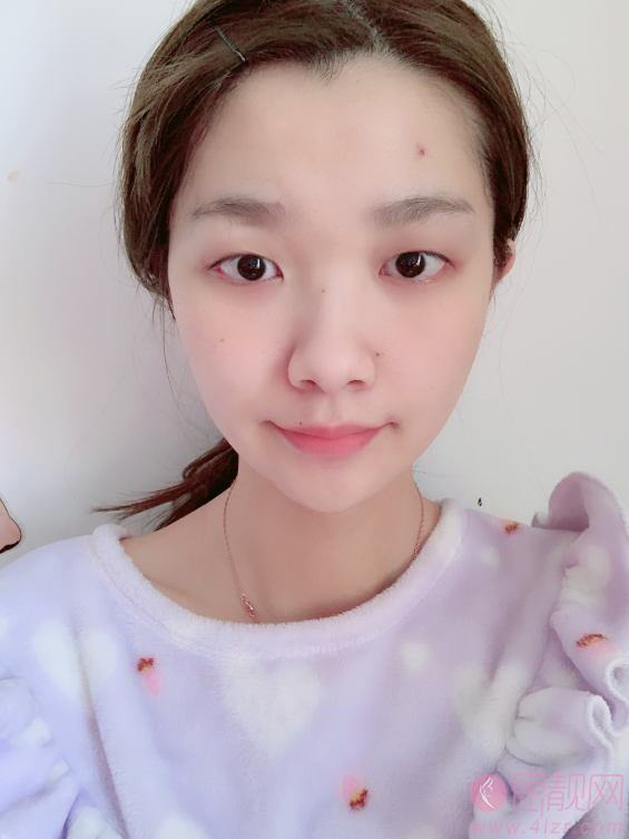万州华美紫馨整形医院形怎么样?2020价格表一览。附双眼皮案例