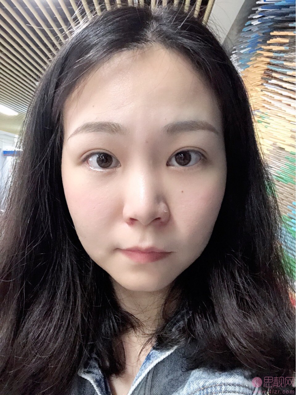 浙江大学医学院附属第二医院整形科怎么样?2020价格表一览+鼻翼缩小案例