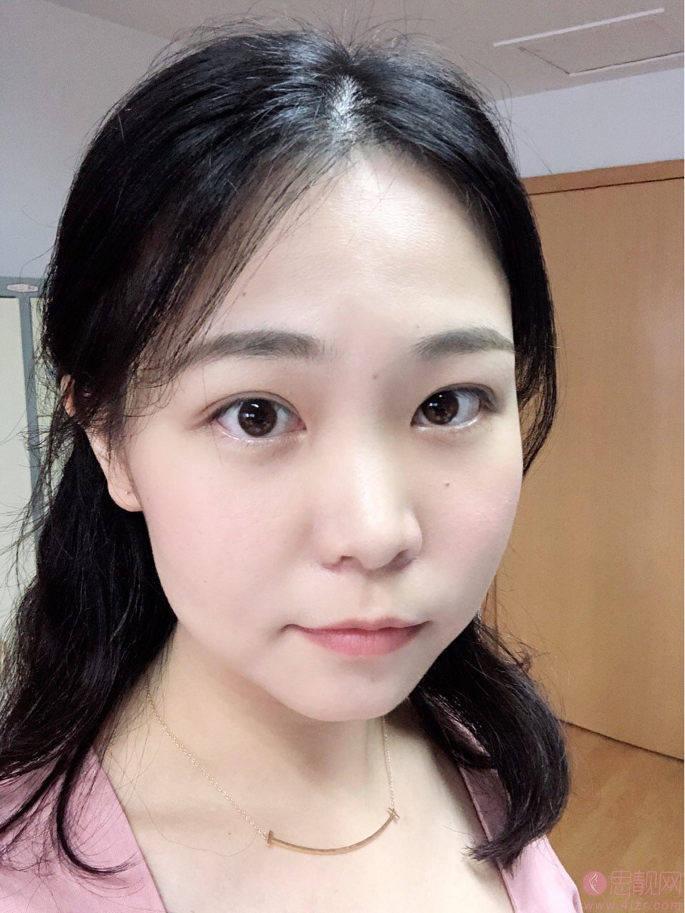 浙江大学医学院附属第二医院整形科怎么样?2020价格表一览+鼻翼缩小案例