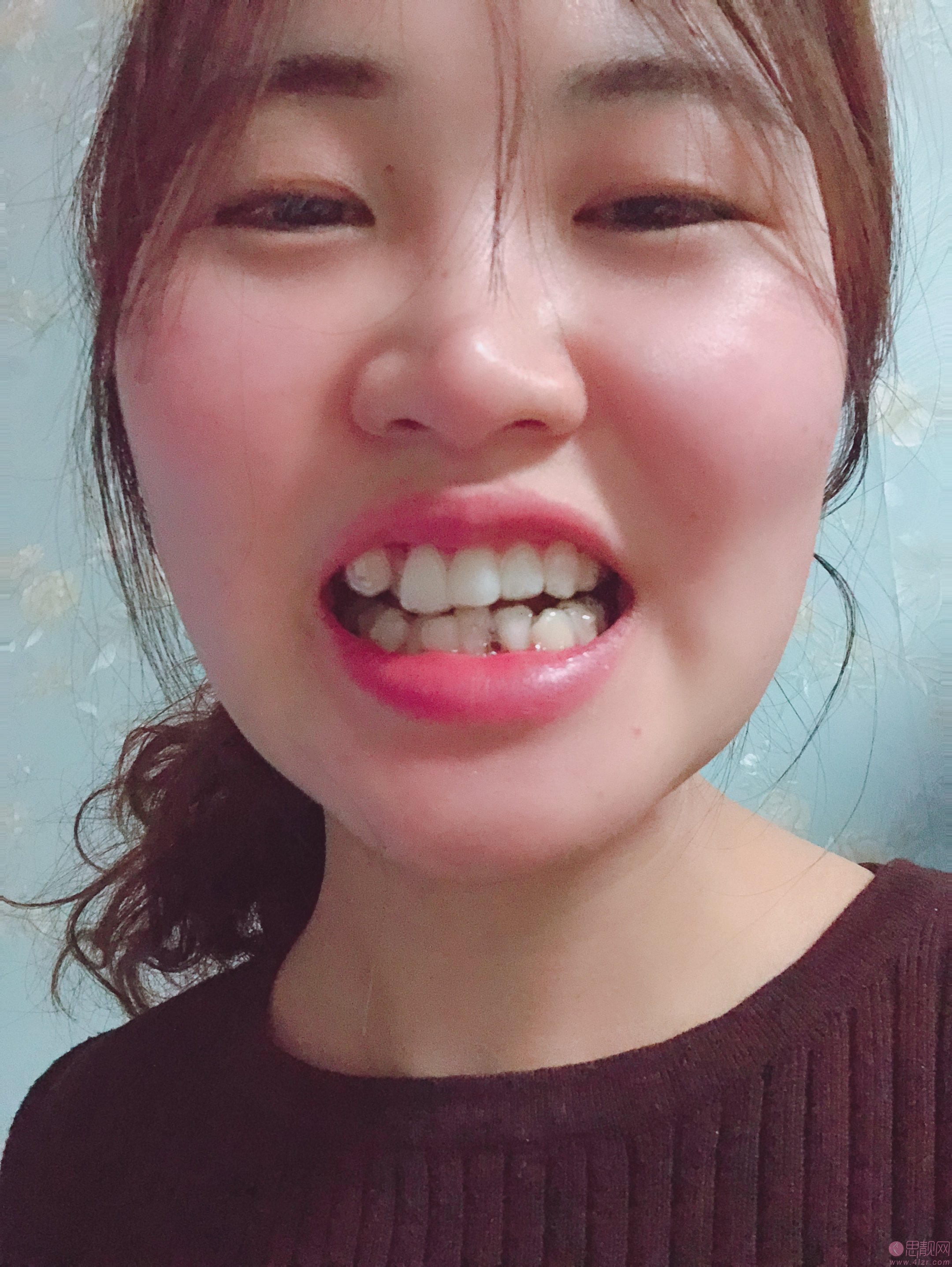 上海薇琳美学齿科牙齿矫正怎么样?价格表一览2020最新出炉