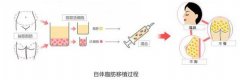 自体脂肪隆鼻能维持多久?