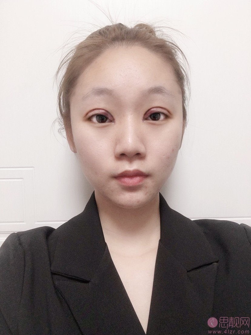 上海欧莱美医疗美容医院李强做双眼皮怎么样？2020价格表一览