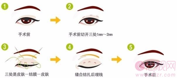 埋线双眼皮做失败了怎么办?