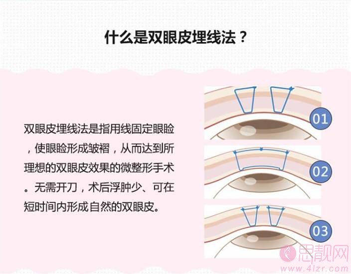 埋线双眼皮做失败了怎么办?