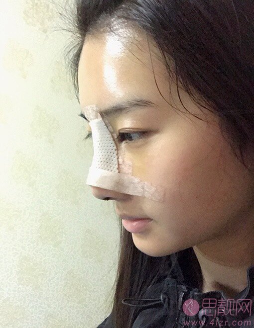 武汉一美医疗美容李兰华隆鼻怎么样?2020价格表一览