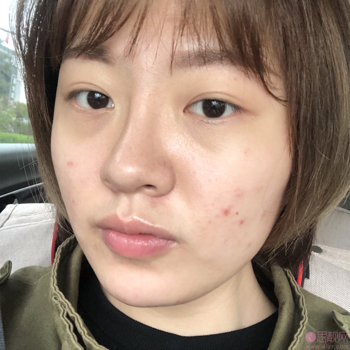 天津菲丝澜医疗美容党涛做双眼皮怎么样?2020价格表一览