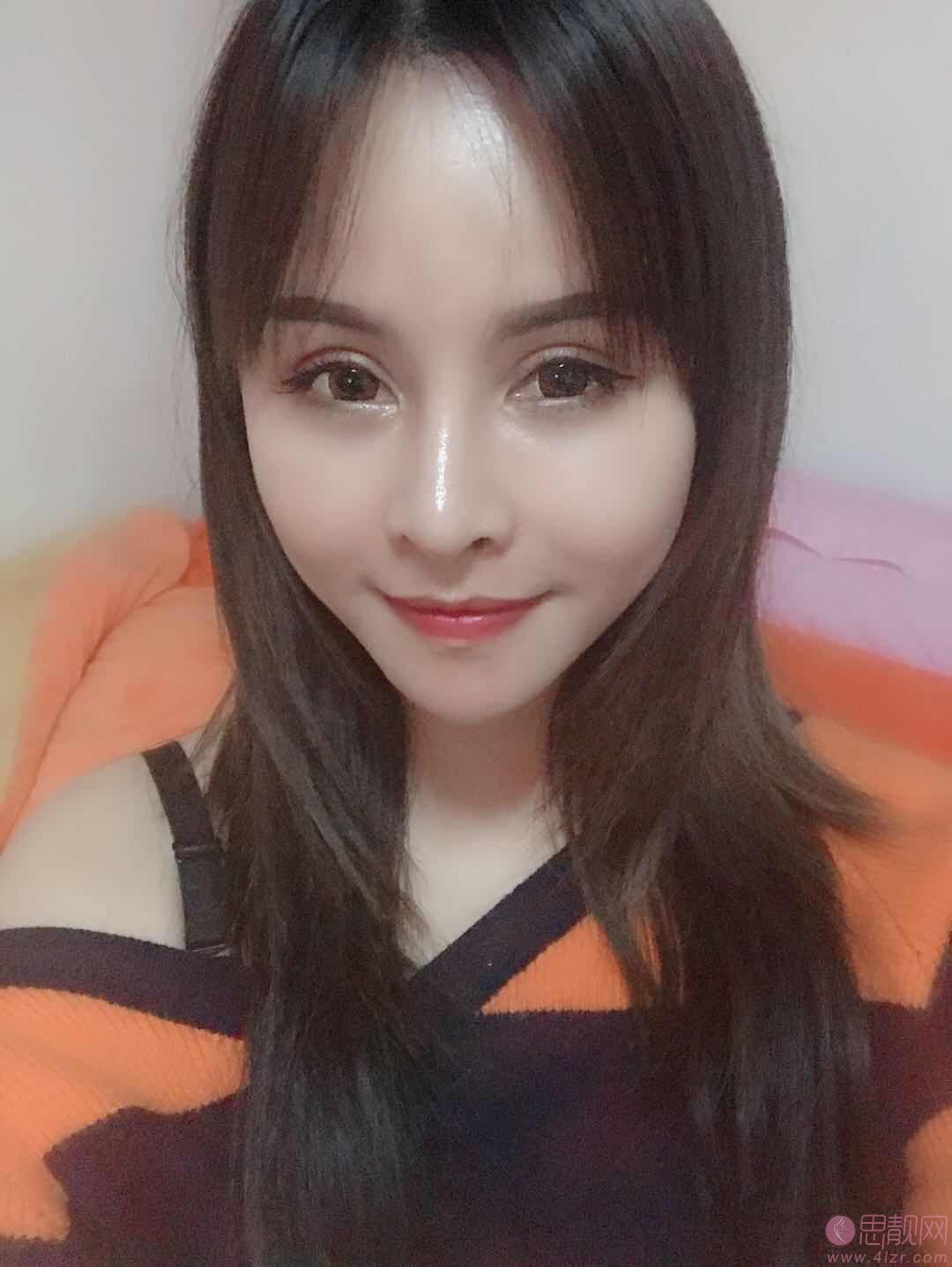 广州艺美医疗美容门诊部李闯隆鼻怎么样？2020价格表一览+隆鼻案例欣赏