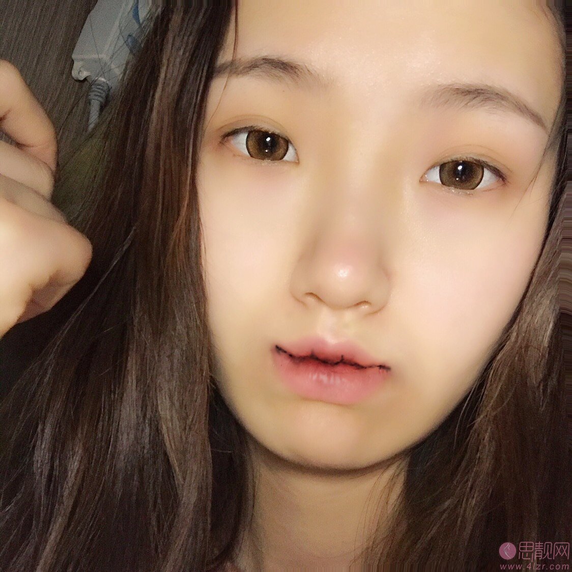 成都医大医院整形美容科2020价格表一览+李辉M唇手术案例