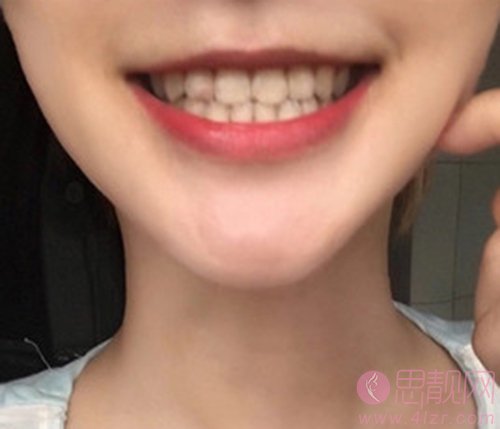 南京牙博士口腔新街口机构？2020价格表一览，附牙齿美白案例