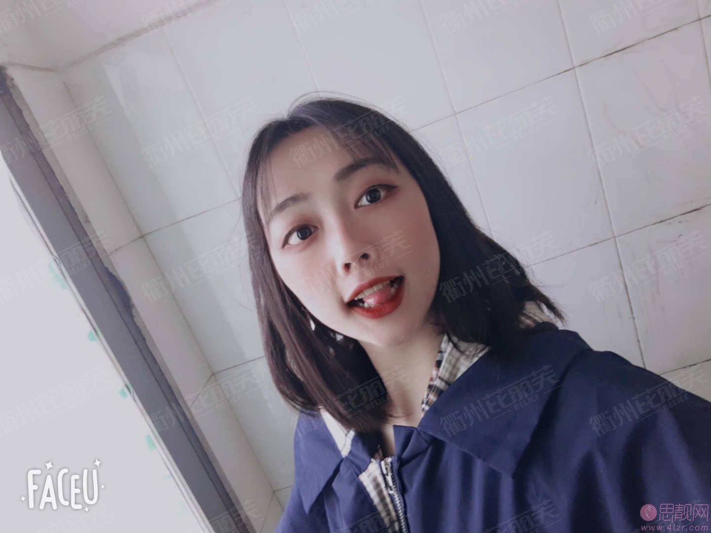 衢州芘丽芙美容医院做双眼皮怎么样?2020价格表一览+双眼皮案例分享