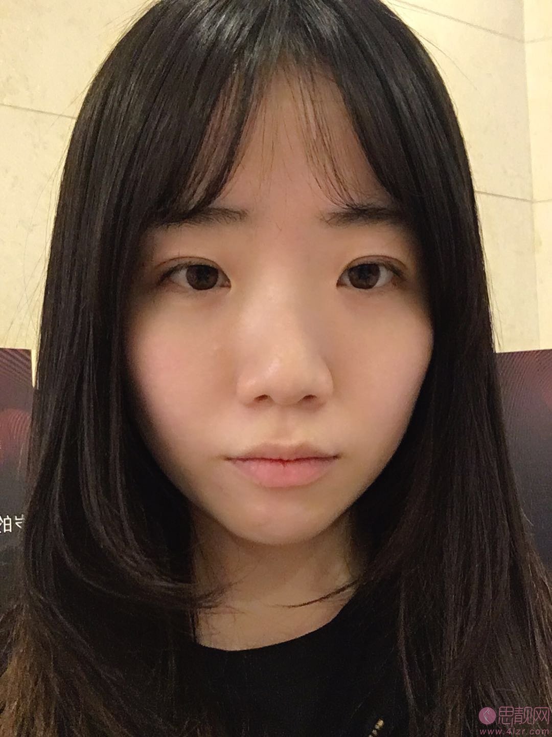 成都美极医疗美容隆鼻怎么样？附隆鼻前后对比及2020价格表一览
