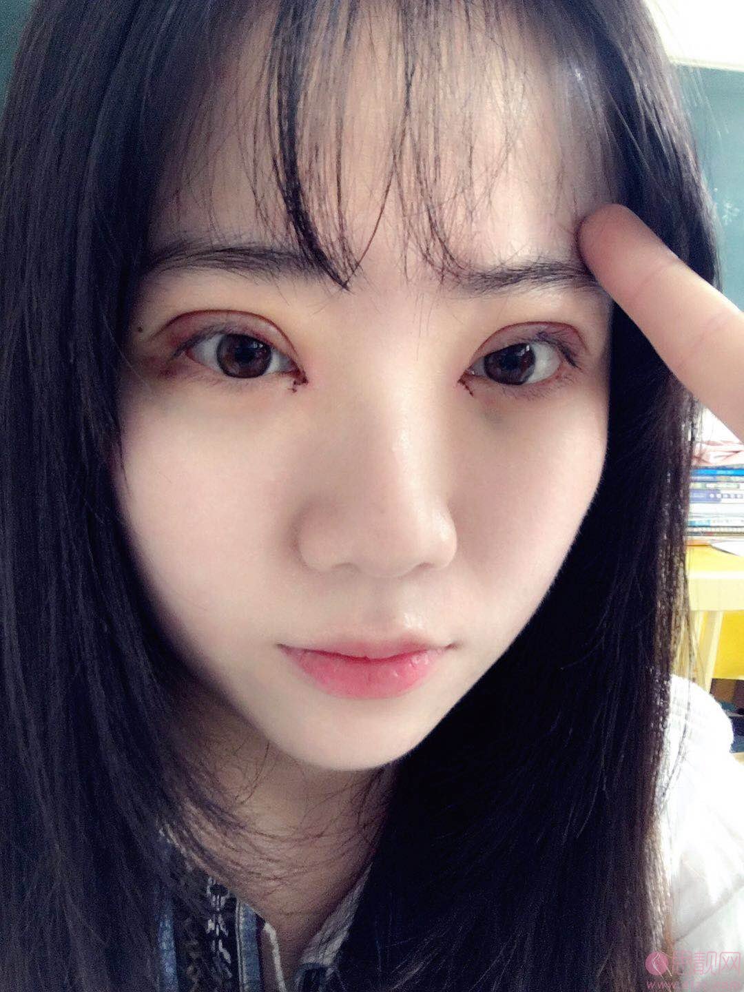 成都美极医疗美容隆鼻怎么样？附隆鼻前后对比及2020价格表一览