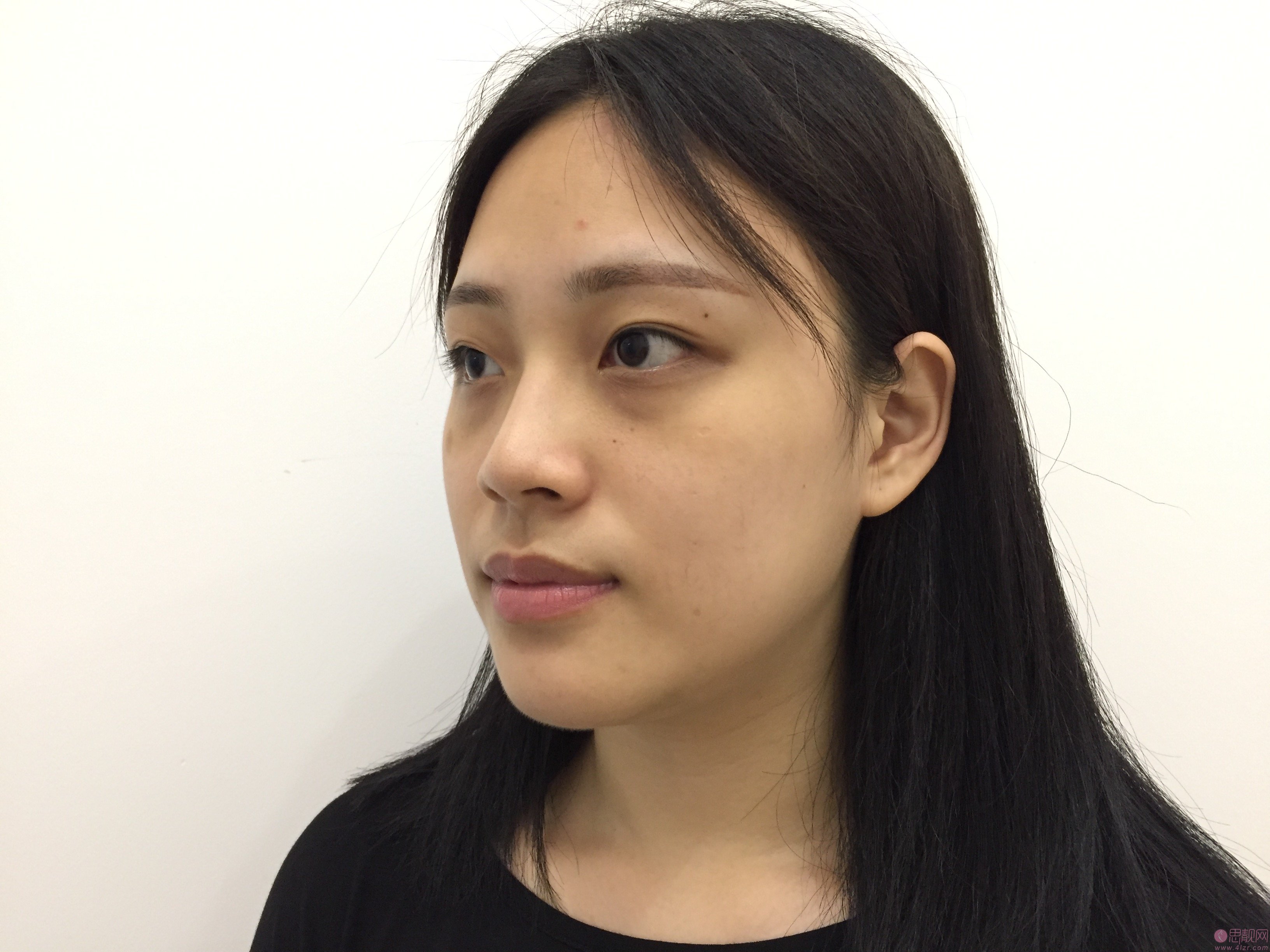 成都美芯东裕医疗美容整形雷元清做双眼皮怎么样?2020价格表一览