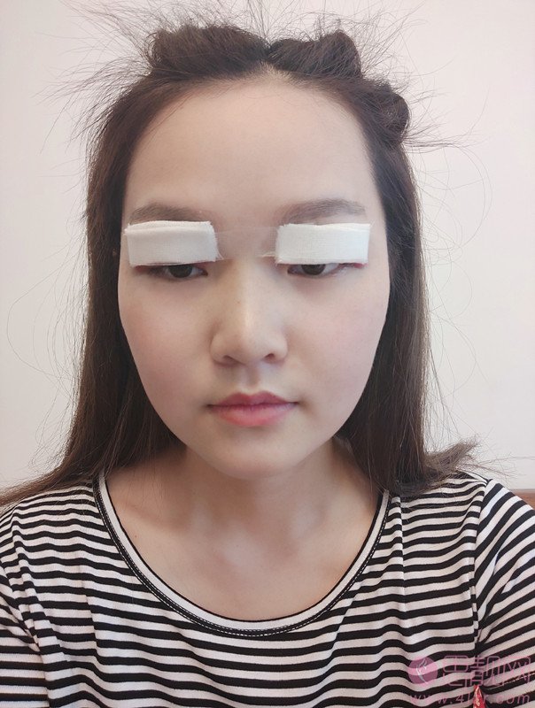 成都美芯东裕医疗美容整形雷元清做双眼皮怎么样?2020价格表一览