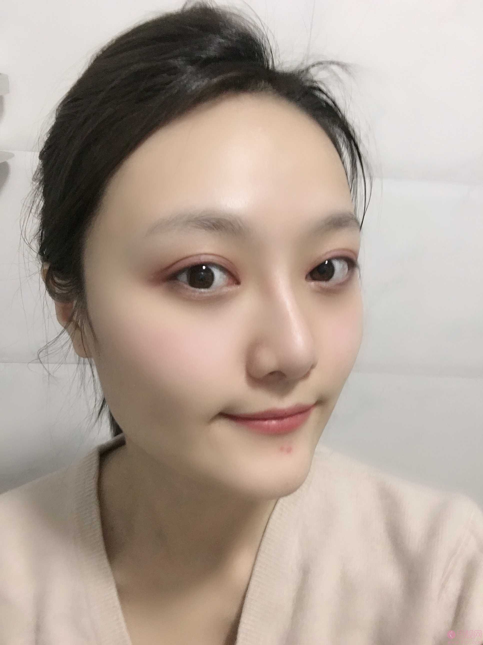 成都美绽美整形美容医院杨平做双眼皮怎么样？2020价格表一览