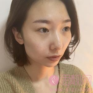 成都纽莱茵医疗美容孙熙东做双眼皮怎么样？2020价格表一览+双眼皮案例前后对比