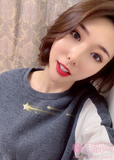 成都纽莱茵医疗美容孙熙东做双眼皮怎么样？2020价格表一览+双眼皮案例前后对比