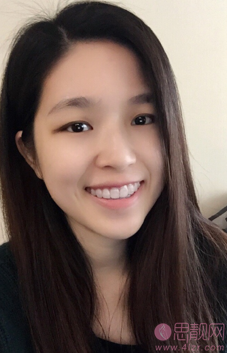 郑州植得口腔医院张玉璟牙齿隐形矫正怎么样？附矫正案例及2020最新价格表一览