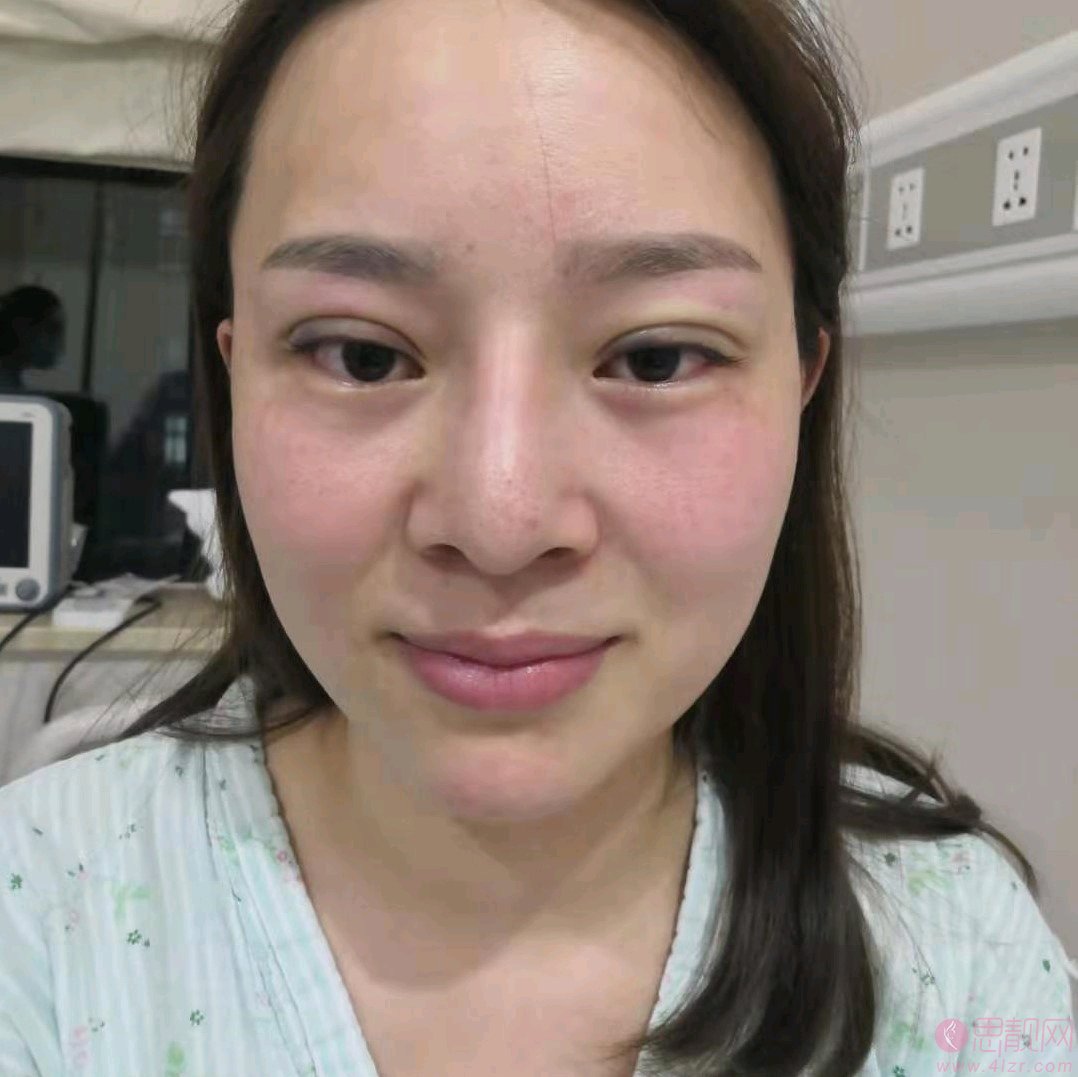 智美颜和医疗美容(外滩总院) 唐玲隆鼻怎么样？附隆鼻前后对比案例及2020价格表一览