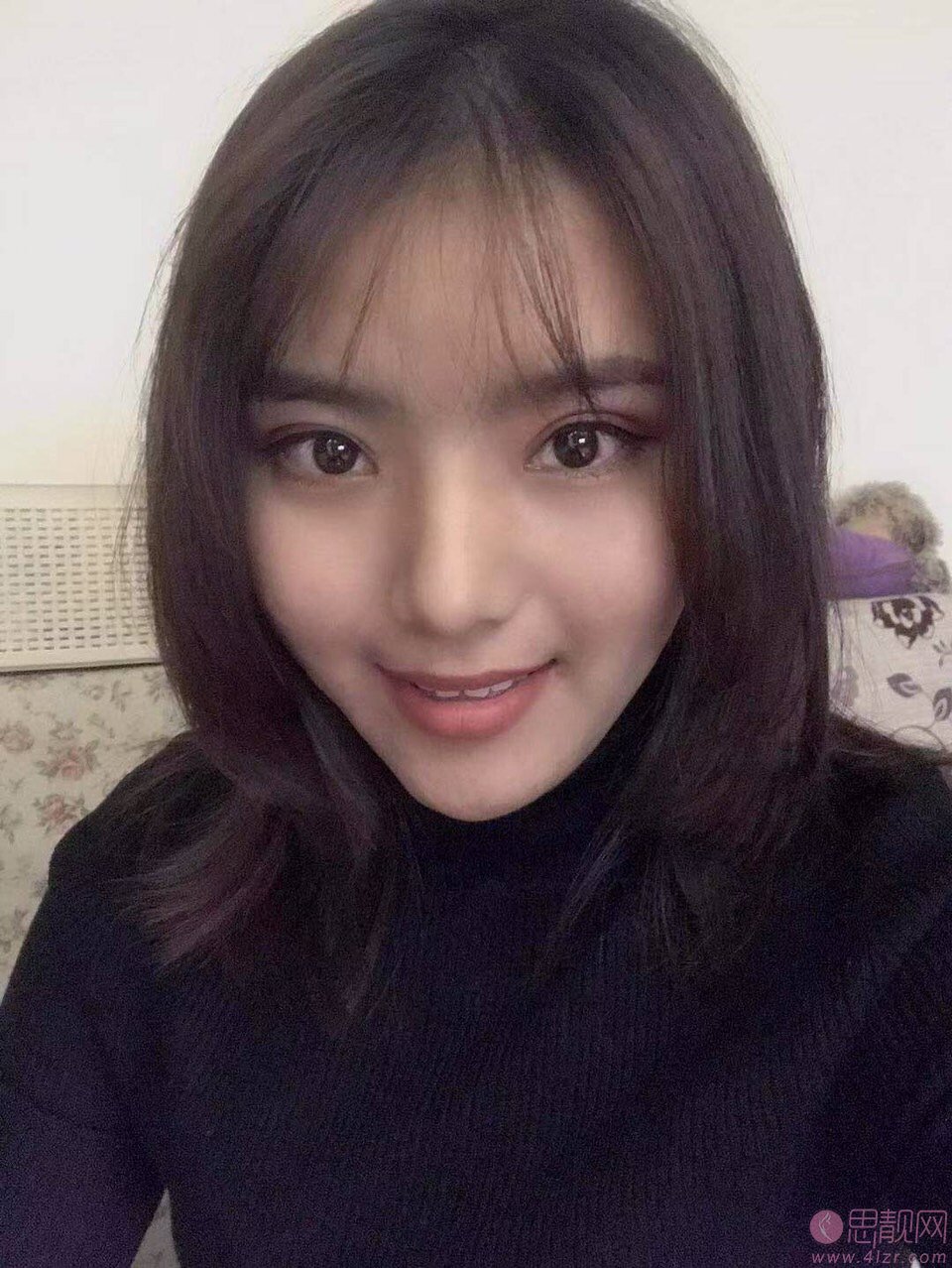 成都百龄医疗美容整形医院王超做双眼皮怎么样？附双眼皮案例一览+2020价格表曝光