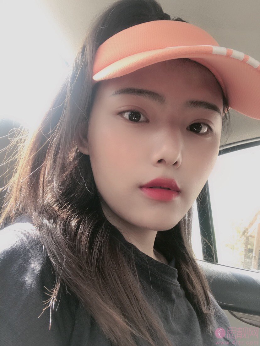 成都百龄医疗美容整形医院王超做双眼皮怎么样？附双眼皮案例一览+2020价格表曝光