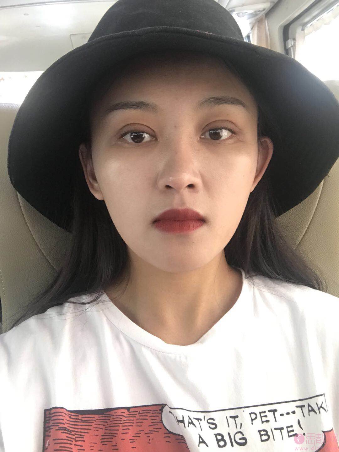 四川美莱医学美容医院黄小林做双眼皮好不好？附双眼皮案例一览+2020最新价格表出炉