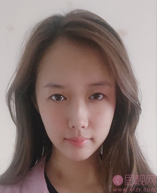 厦门长庚医院整形美容科2020价格表一览+双眼皮案例效果展示