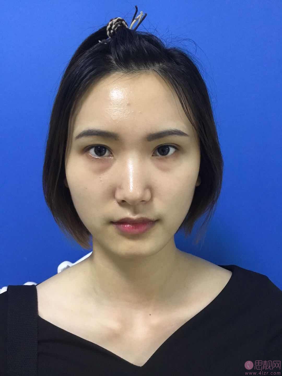 厦门思明云艺美整形外科门诊部刘爱茹祛眼袋怎么样?2020价格表一览+祛眼袋前后对比