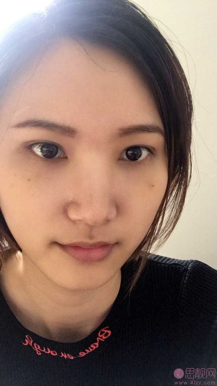 厦门思明云艺美整形外科门诊部刘爱茹祛眼袋怎么样?2020价格表一览+祛眼袋前后对比
