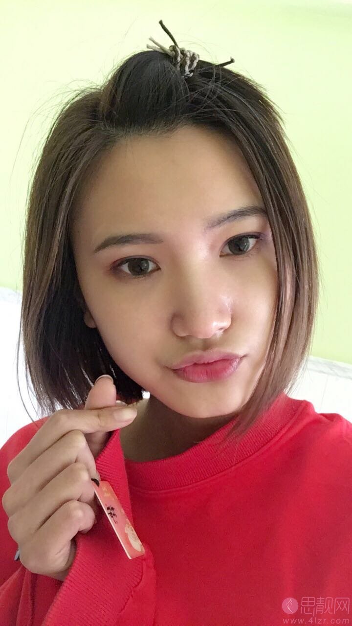 厦门思明云艺美整形外科门诊部刘爱茹祛眼袋怎么样?2020价格表一览+祛眼袋前后对比