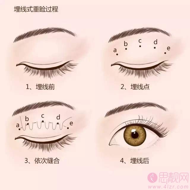 韩式埋线双眼皮多少钱?