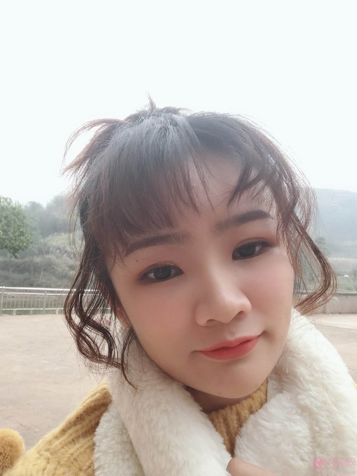 厦门银河整形外科门诊部柴天举自体脂肪填充全脸怎么样？2020价格表一览+填充案例分享