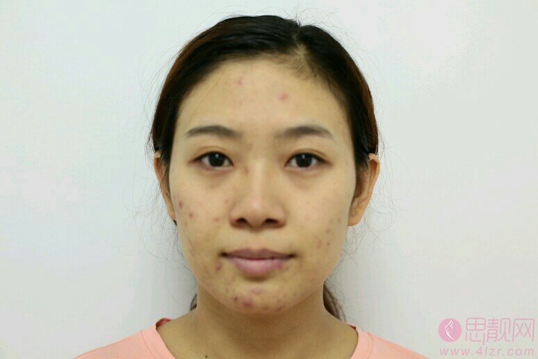 厦门伊美整形美容门诊部祛痘怎么样？附祛痘案例对比及2020价格表曝光