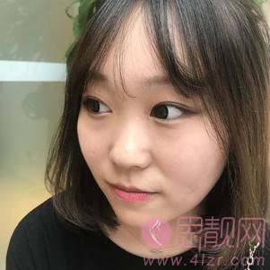 成都医美整形杨丽璇隆鼻好不好？附隆鼻案例对比及2020价格表一览