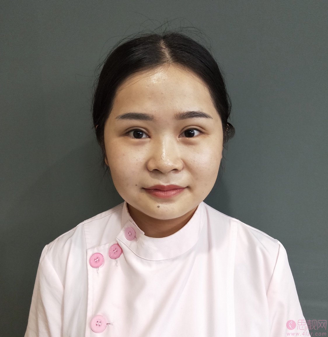成都鹏爱悦己医疗美容医院隆鼻怎么样?附隆鼻案例及2020价格表一览
