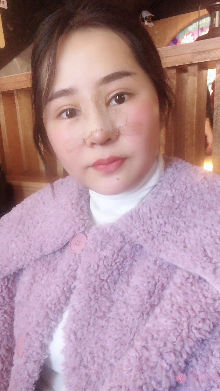 成都鹏爱悦己医疗美容医院隆鼻怎么样?附隆鼻案例及2020价格表一览