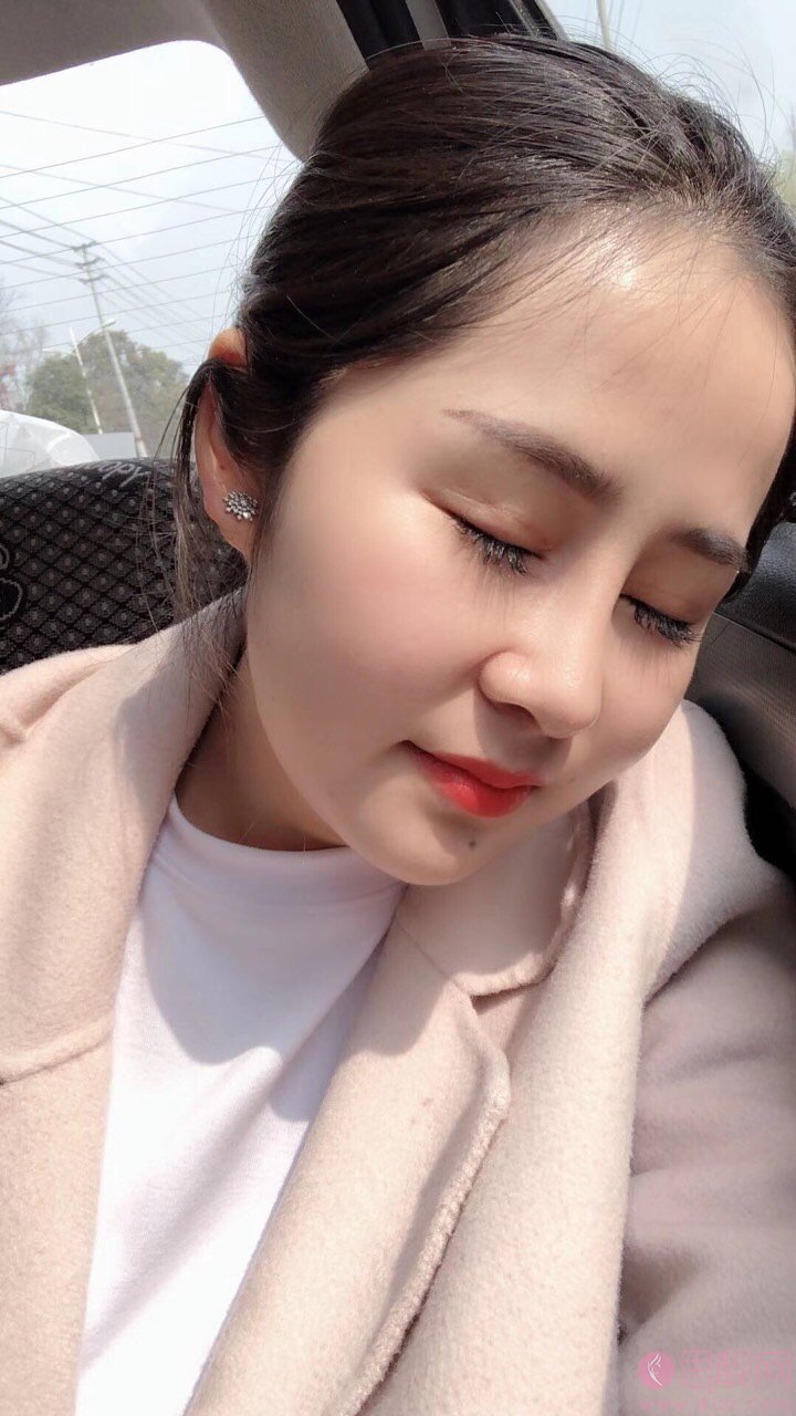 成都鹏爱悦己医疗美容医院隆鼻怎么样?附隆鼻案例及2020价格表一览