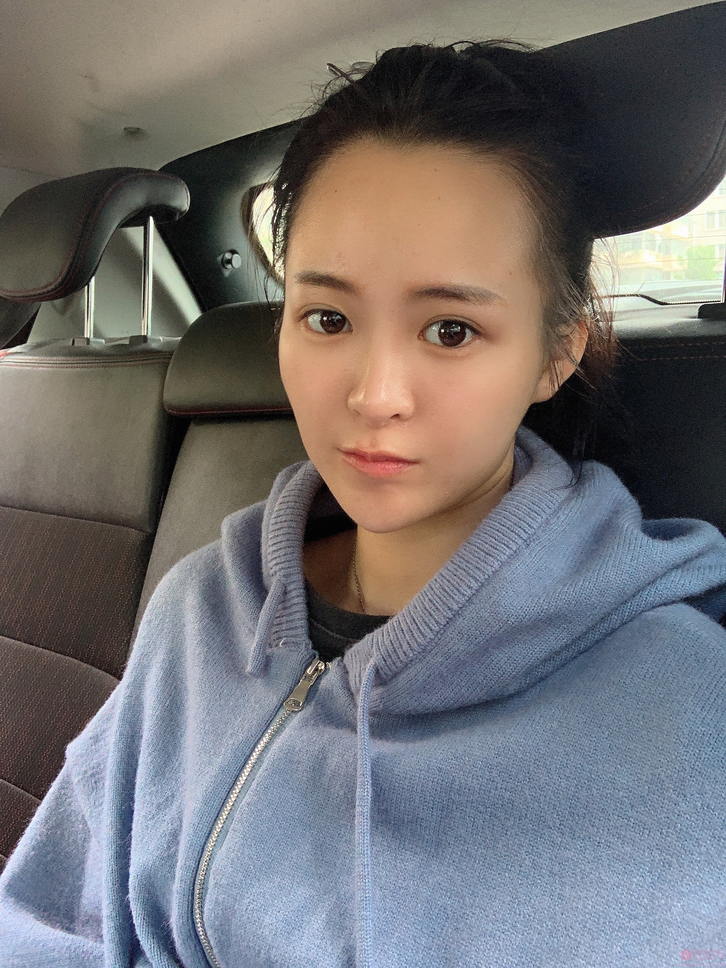 成都赵善军博士整形自体脂肪全脸填充好不好?2020价格表出炉+填充案例前后对比
